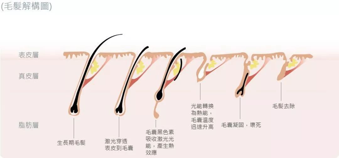 “白煮蛋”與“獼猴桃”之間，還差一個它 強(qiáng)脈沖脫毛器械，值得買嗎？